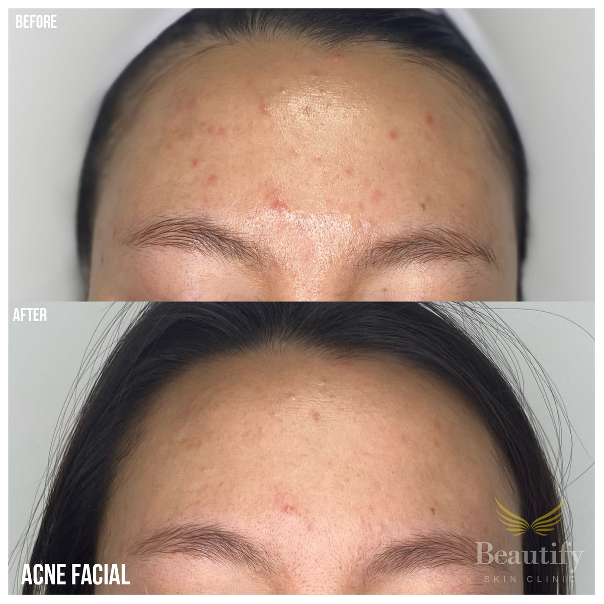 acnefacial.png